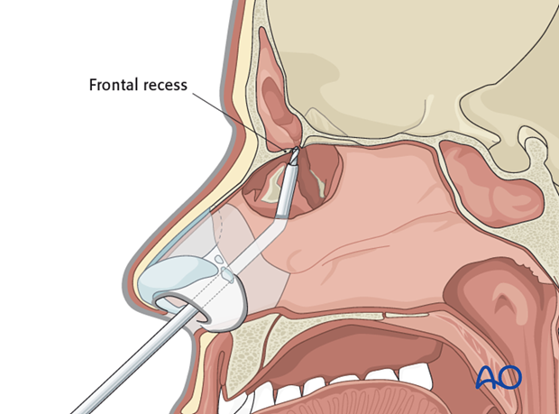 Endoscopic transnasal approach to the frontal sinus