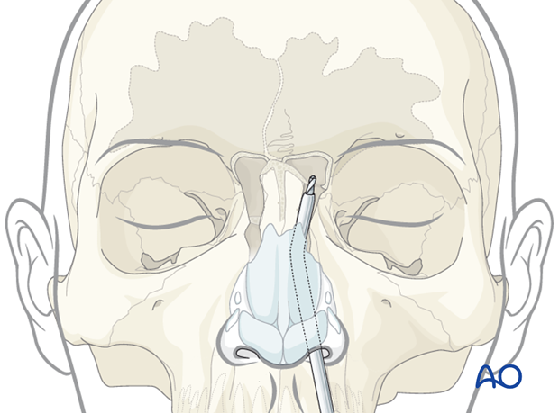 Endoscopic transnasal approach to the frontal sinus