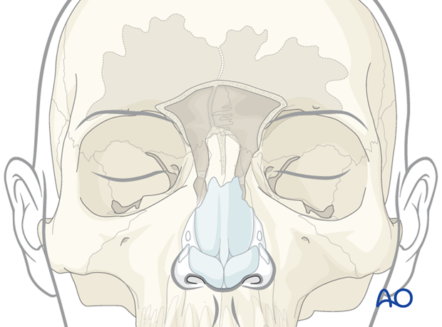 Endoscopic transnasal approach to the frontal sinus