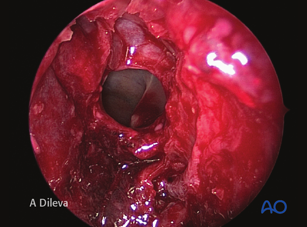 Endoscopic approach to the central skull base