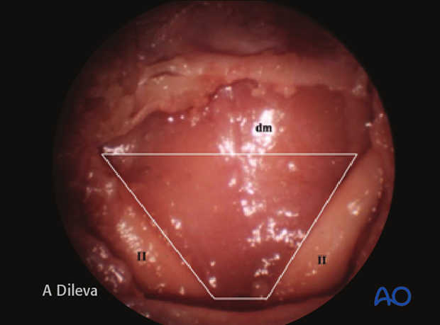 Endoscopic approach to the central skull base