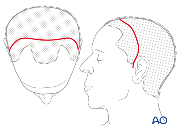 Location of scalp incision line