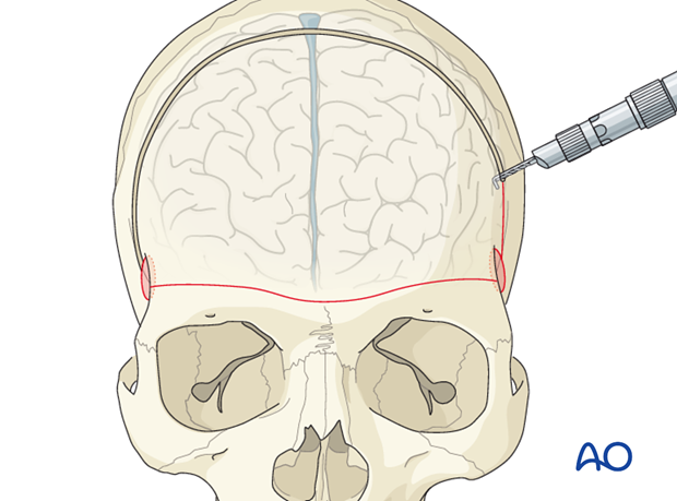 Craniotomy