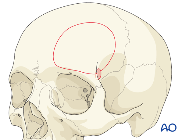 Craniotomy