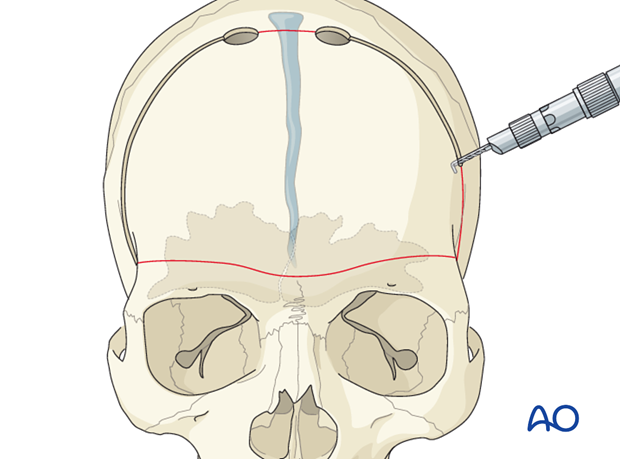 Craniotomy