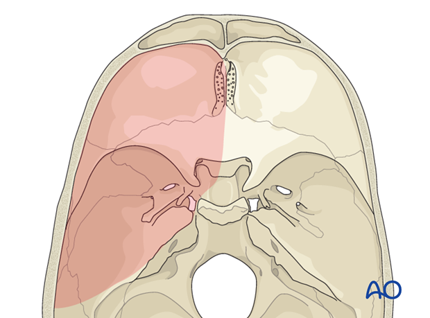 Lateral skull base approach