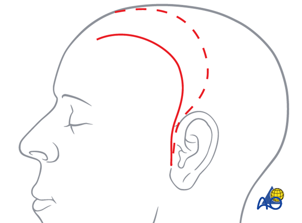 Lateral skull base approach