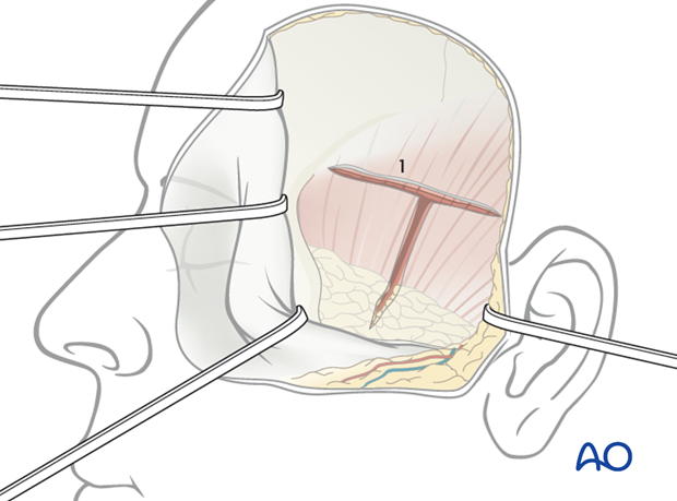 Lateral skull base approach