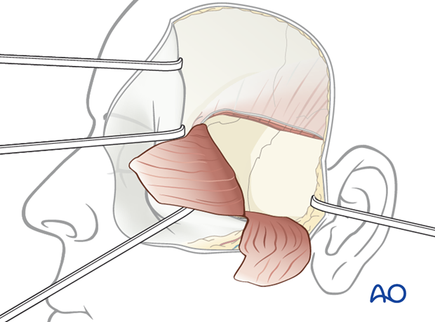 Lateral skull base approach