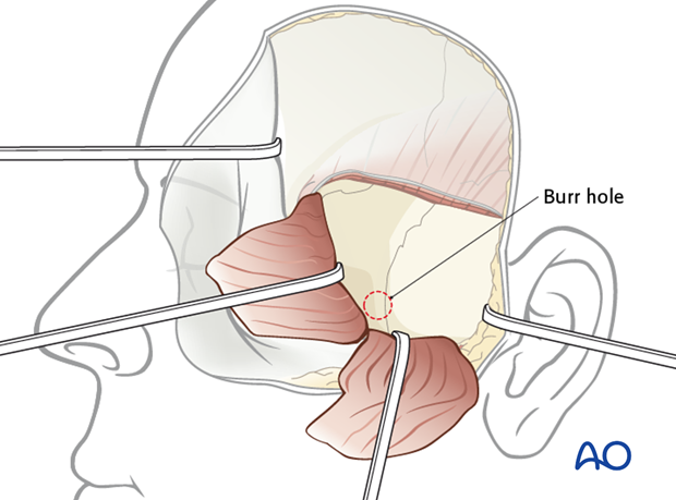 Lateral skull base approach