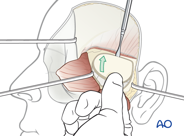 Lateral skull base approach