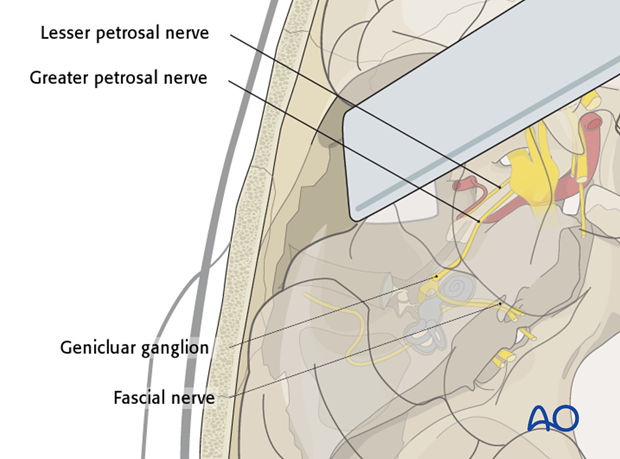 Lateral skull base approach