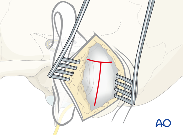 T-shaped periosteum incision