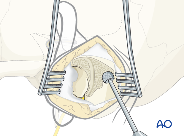 Exposure of the facial nerve