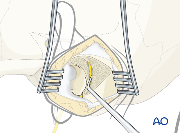 Outline of the facial nerve