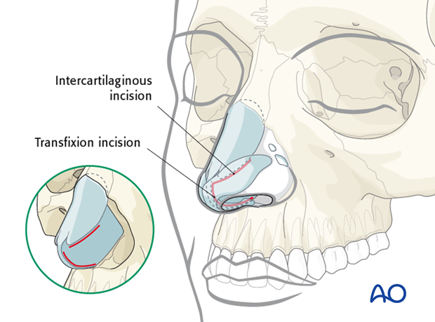 Endonasal approaches (transfixion incision and intercartilaginous incisions)