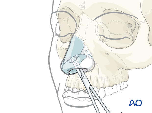 Endonasal approaches (transfixion incision and intercartilaginous incisions)