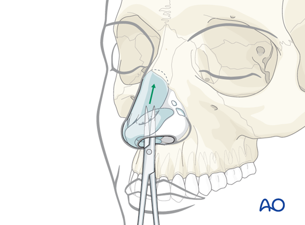 Endonasal approaches (transfixion incision and intercartilaginous incisions)