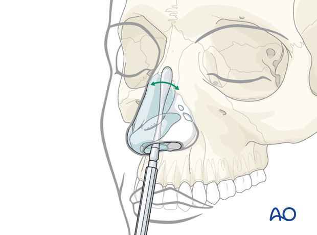 Endonasal approaches (transfixion incision and intercartilaginous incisions)