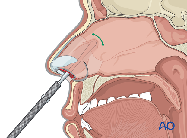 Endonasal approaches (transfixion incision and intercartilaginous incisions)