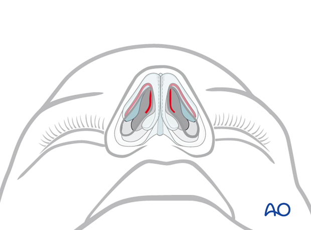 External rhinoplasty approach (open)