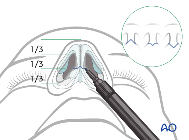 External rhinoplasty approach (open)