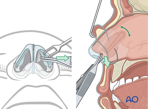 External rhinoplasty approach (open)