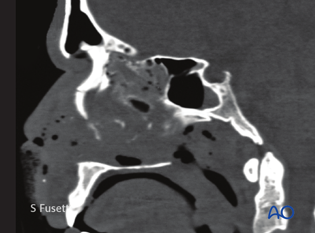 Diagnosis of NOE fractures