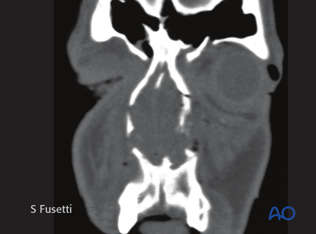 Diagnosis of NOE fractures