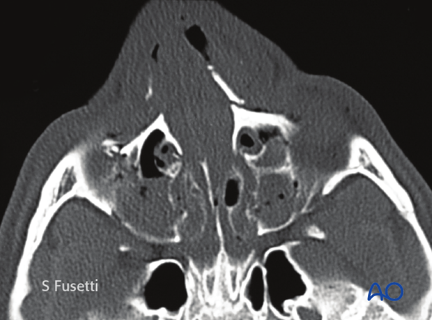 Diagnosis of NOE fractures