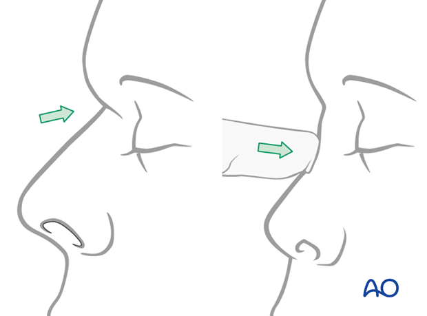 Diagnosis of NOE fractures