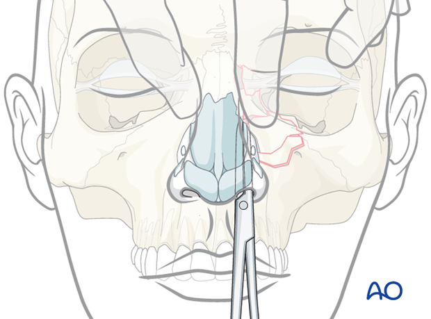 Diagnosis of NOE fractures