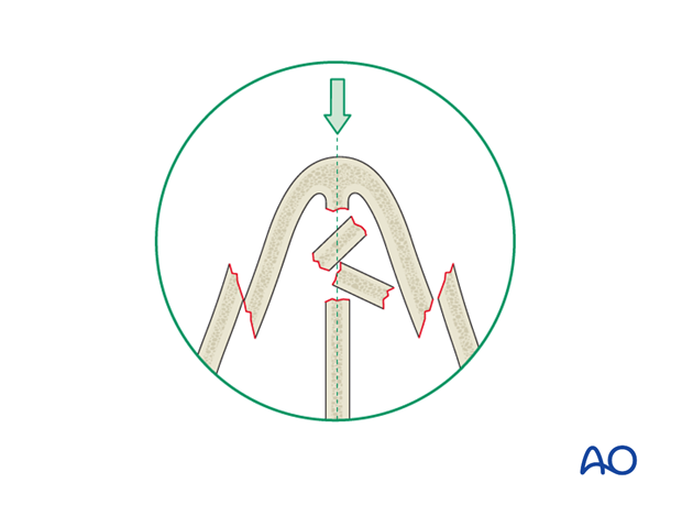 Diagnosis of nasal fractures