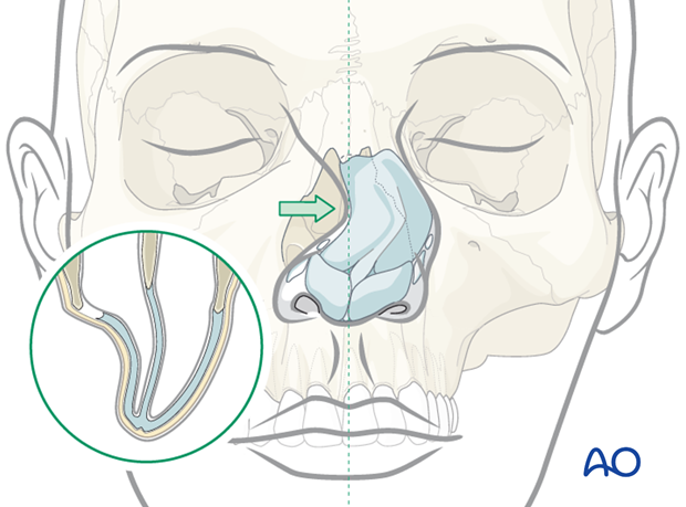 Diagnosis of nasal fractures