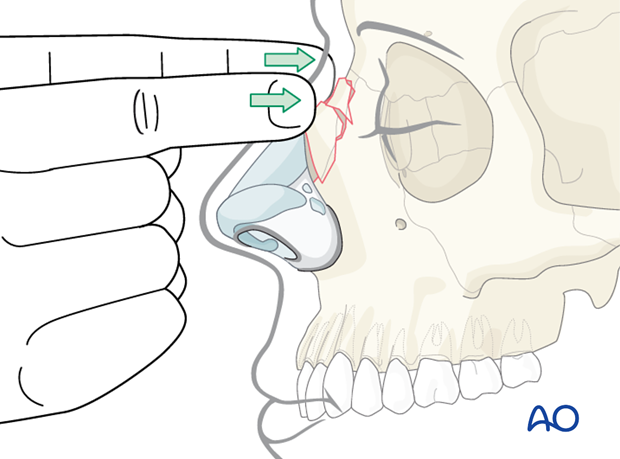 Diagnosis of nasal fractures