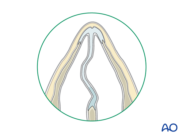 Diagnosis of nasal fractures