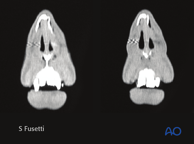 Diagnosis of nasal fractures