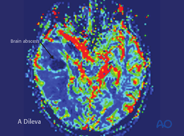 Brain abscess