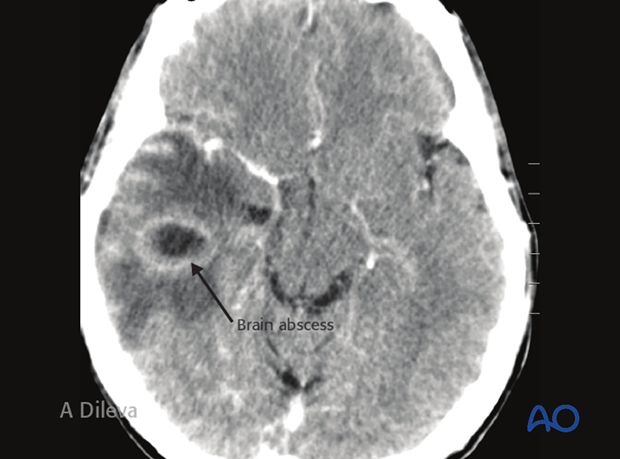 Brain abscess