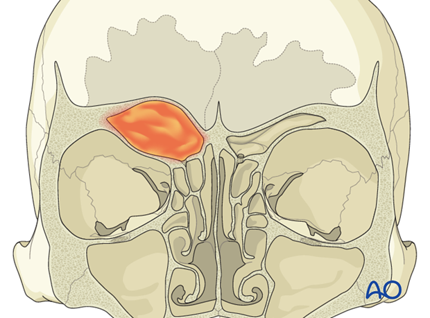 Operative techniques: Transnasal endoscopic approach