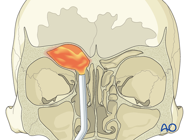 Operative techniques: Transnasal endoscopic approach