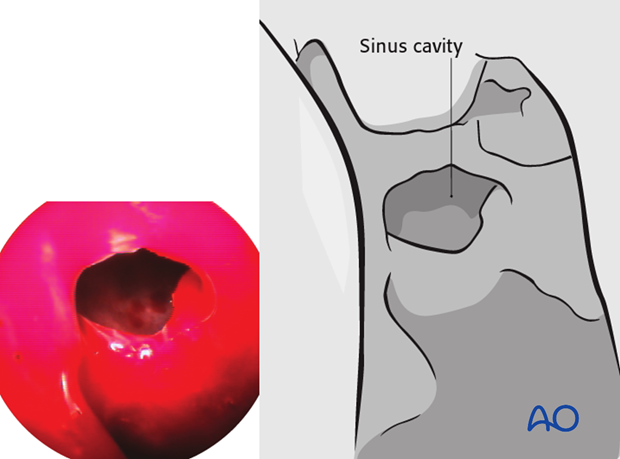 Operative techniques: Transnasal endoscopic approach