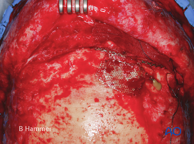 Case example: Partial obliteration of the frontal sinus 