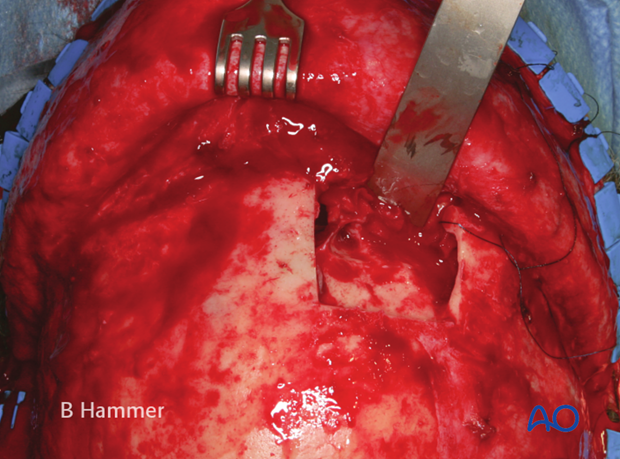 Case example: Partial obliteration of the frontal sinus 