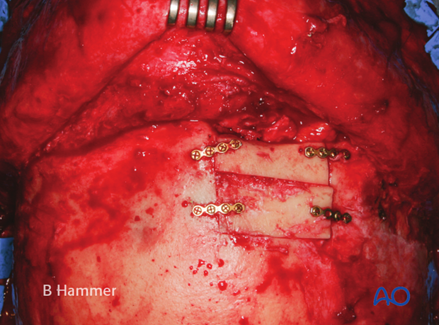 Case example: Partial obliteration of the frontal sinus 