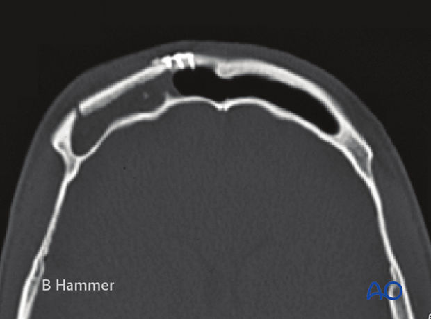 Case example: Partial obliteration of the frontal sinus 