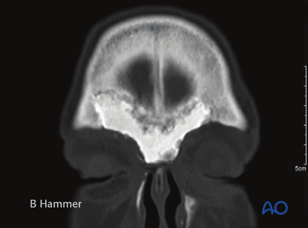 Case example: Infection of a hydroxyapatite graft