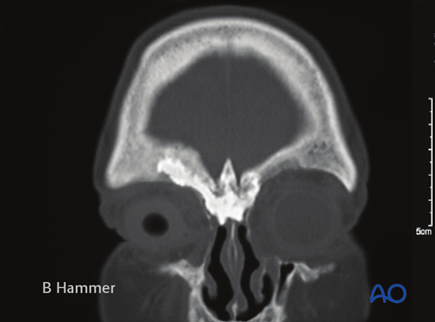 Case example: Infection of a hydroxyapatite graft