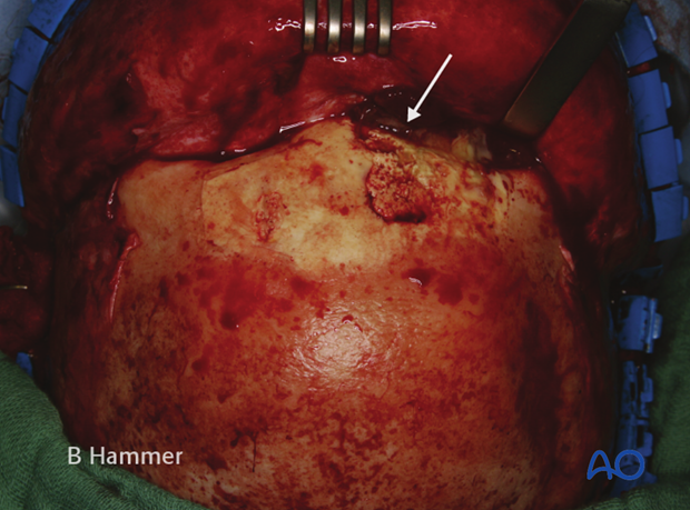 Case example: Infection of a hydroxyapatite graft