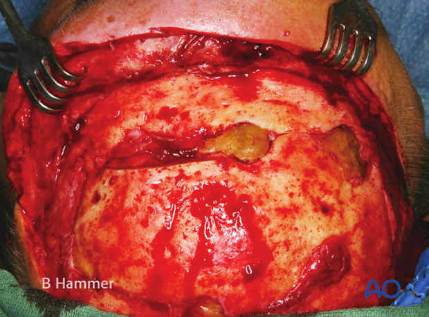 Case example: Infection of a PMMA graft causing recurrent fistulae